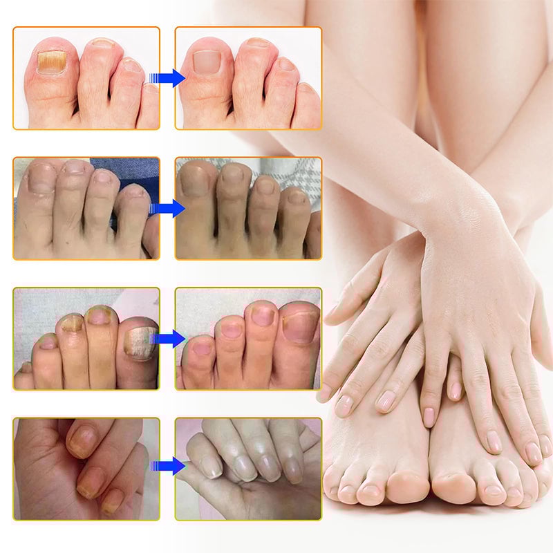 NailRepair™ | Plaster til neglesvamp