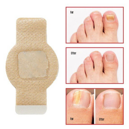 NailRepair™ | Plaster til neglesvamp