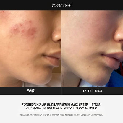 LumaBooster™ | Avanceret Hudpleje til Bedre Hudstruktur og Aknebehandling